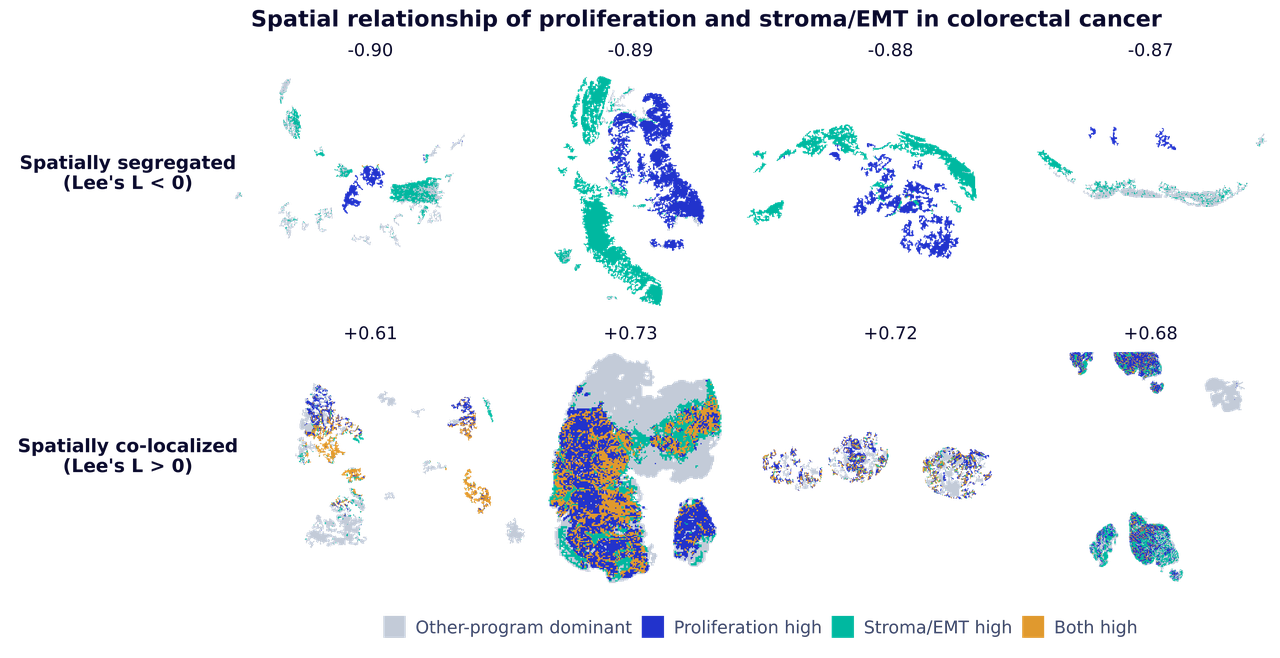 Examples of spatially segregated and co-localized proliferation and stroma or EMT programs.