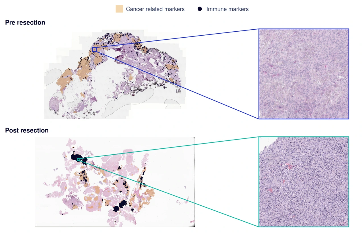 Representative tissue regions and prediction overlays illustrating immune infiltration.