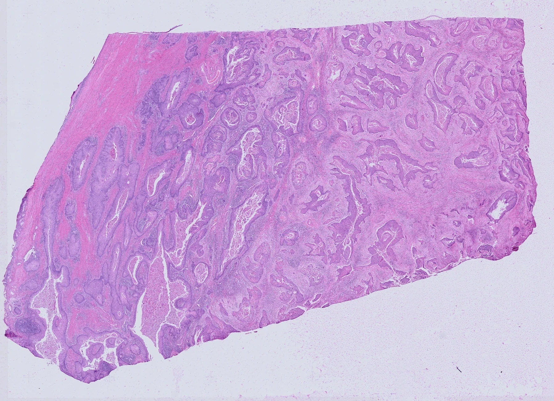 H&E image of an Atera FFPE cervical cancer tissue section
