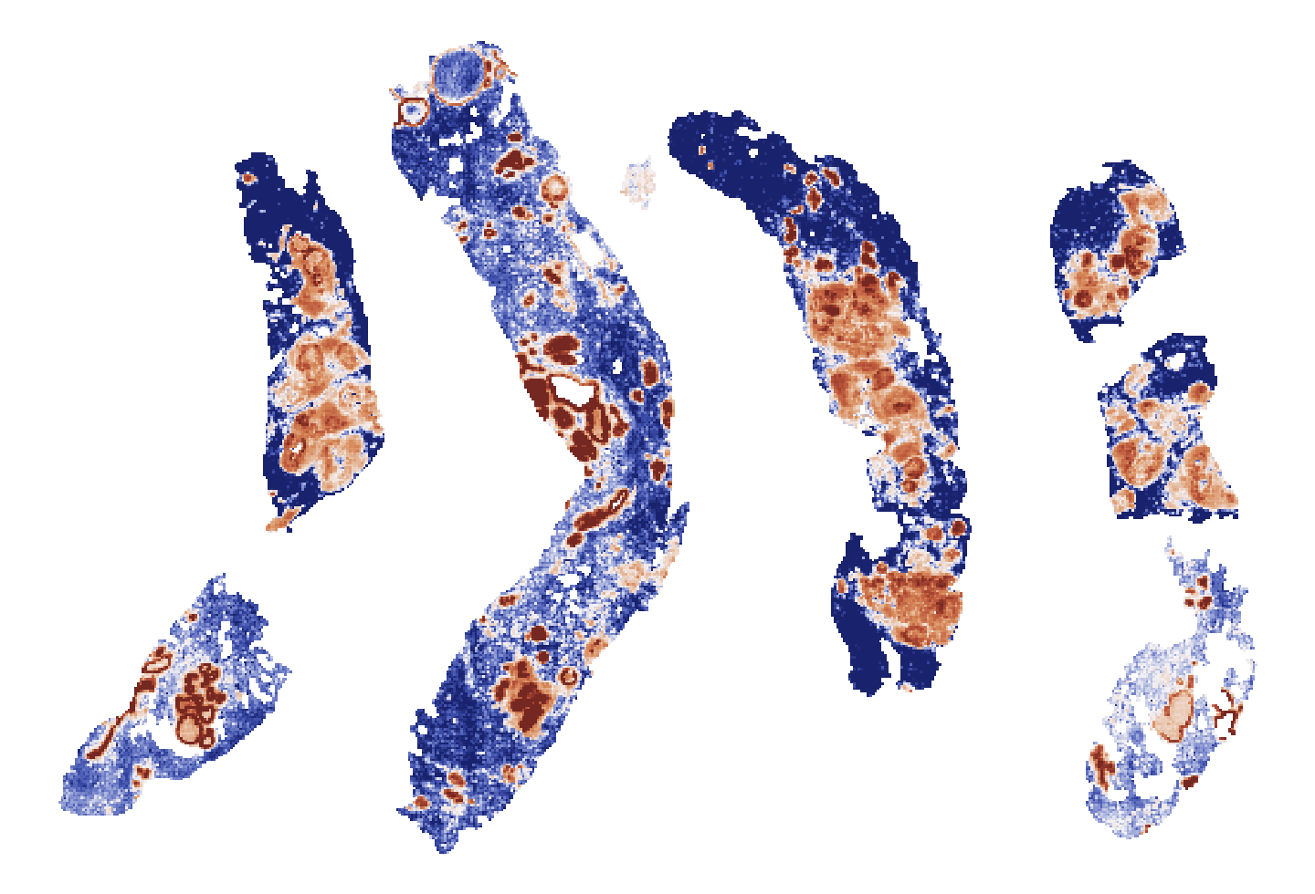 Tile-level EREG predictions forming broad, coherent regions across a triple-negative breast cancer biopsy